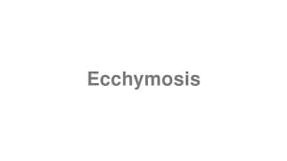 Ecchymosis