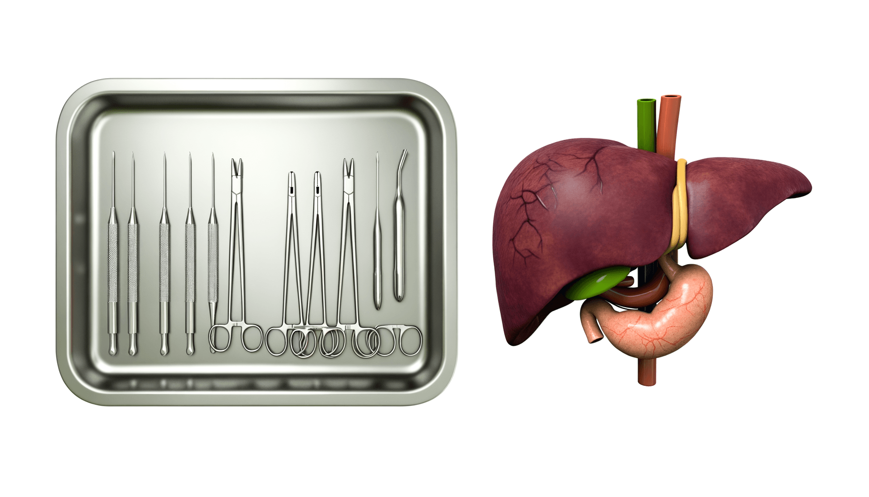 Understanding Cholecystectomy: A Guide to Gallbladder Surgery
